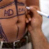 Liposuctie abdominala barbati