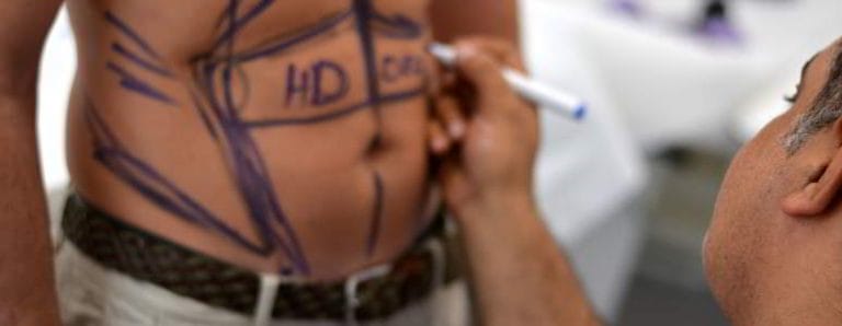 Liposuctie abdominala barbati