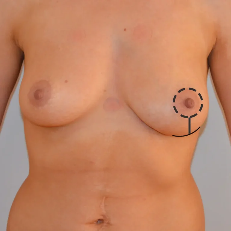 Incizia tip ancora in liftingul mamar Incizia tip ancora in liftingul mamar