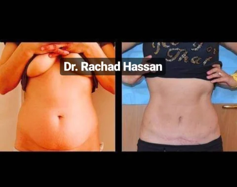 Caz abdominoplastie 003