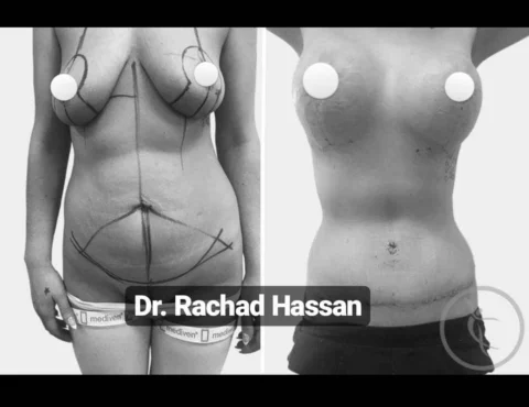 Caz abdominoplastie 005