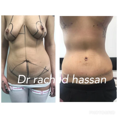 Caz abdominoplastie 007