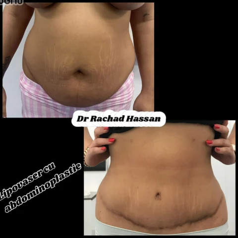 Caz abdominoplastie 009