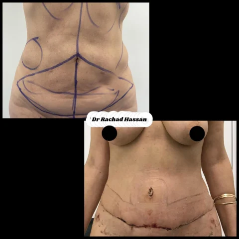 Caz abdominoplastie 010