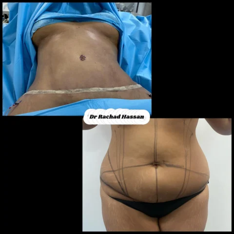 Caz abdominoplastie 011