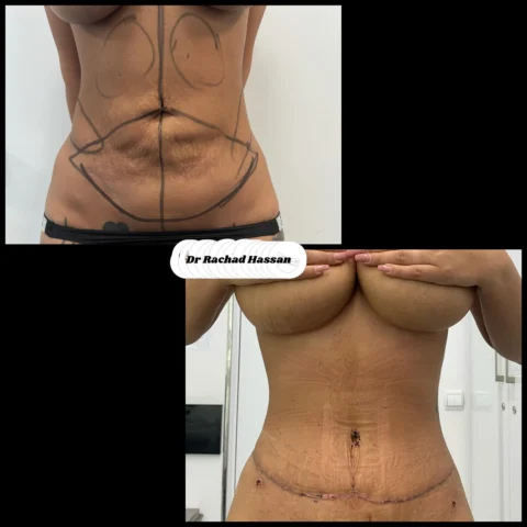 Caz abdominoplastie 013