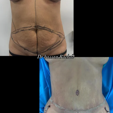 Caz abdominoplastie 014