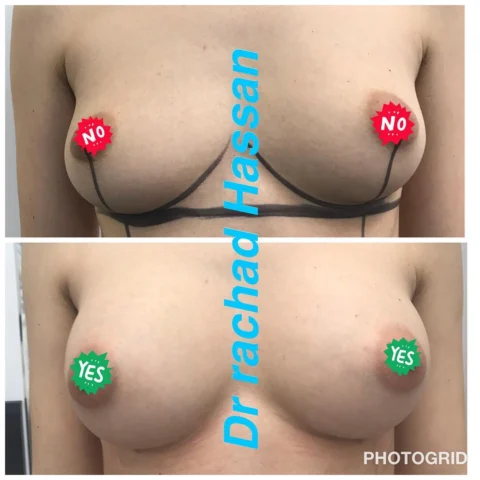 Caz augmentare mamară cu grăsime proprie și implant mamar 001