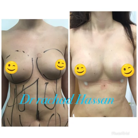Caz augmentare mamară cu grăsime proprie 009