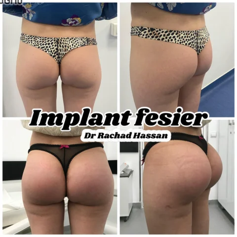 Caz implant fesier 003