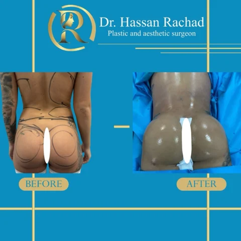 Caz implant fesier 015