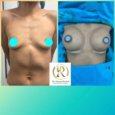 Caz implant mamar 001