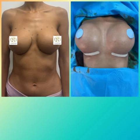 Caz implant mamar 005