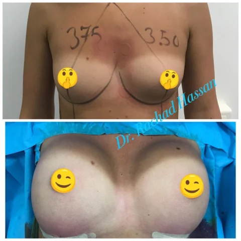 Caz implant mamar și lifting mamar 010