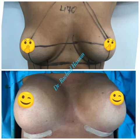 Caz implant mamar și lifting mamar 012