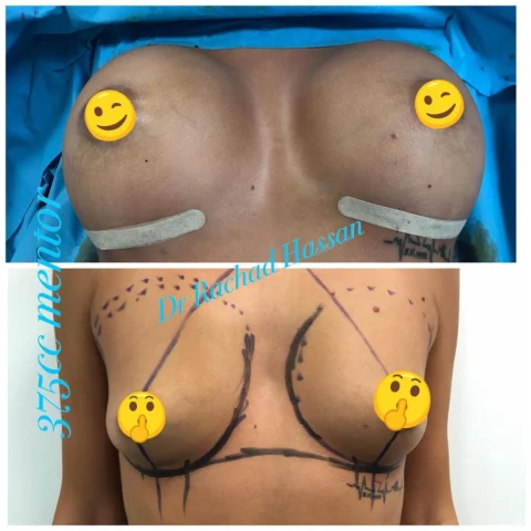 Caz implant mamar și lifting mamar 013