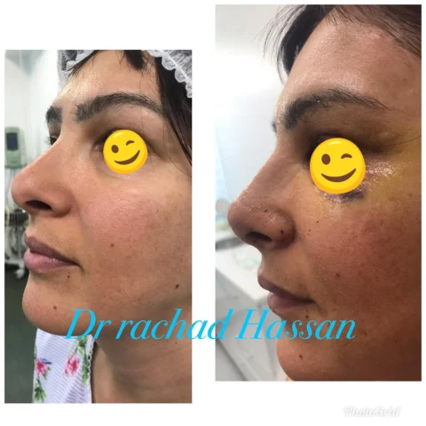 Caz rinoplastie 029