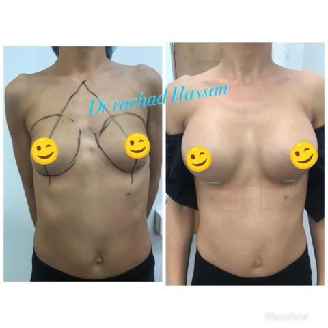 Caz implant mamar 021