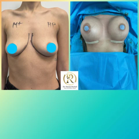 Caz implant mamar 026
