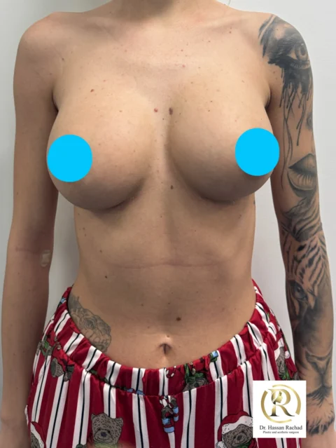 Caz implant mamar 027