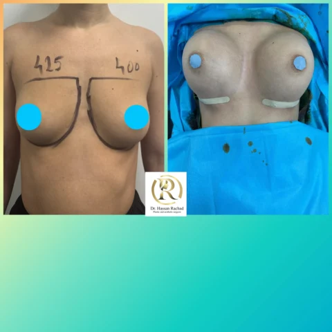 Caz implant mamar 028