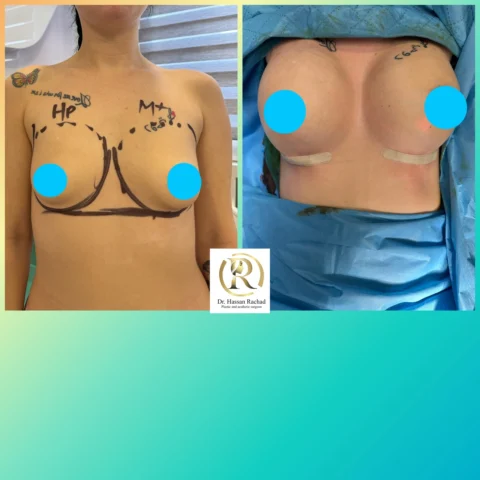 Caz implant mamar 029