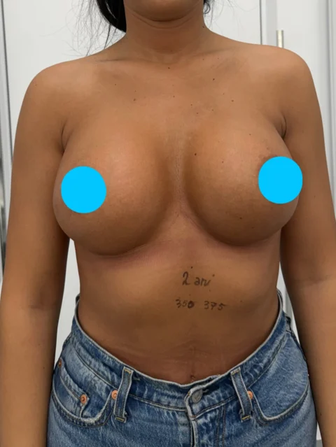 Caz implant mamar 030
