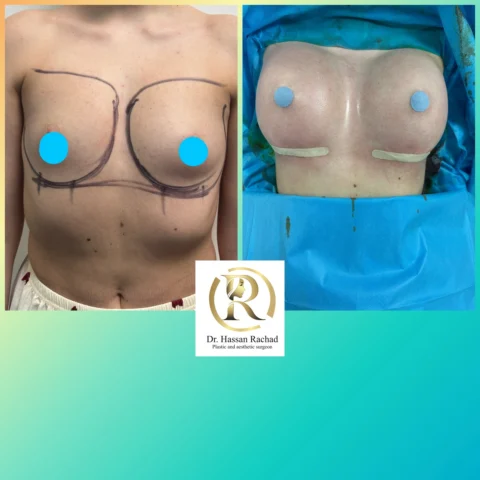 Caz implant mamar 031