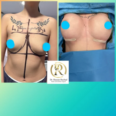 Caz implant mamar 032