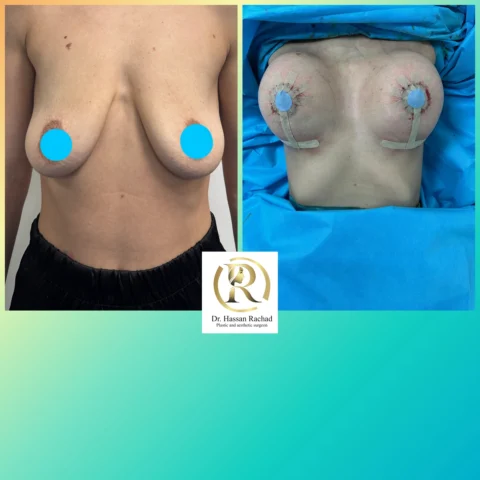 Caz implant mamar 033