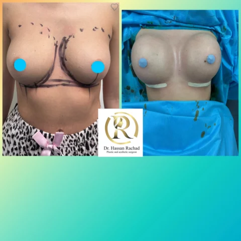 Caz implant mamar 035