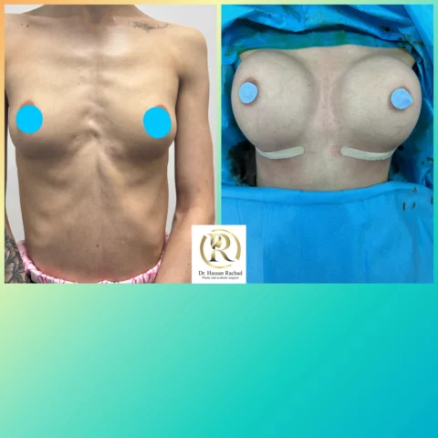 Caz implant mamar 036