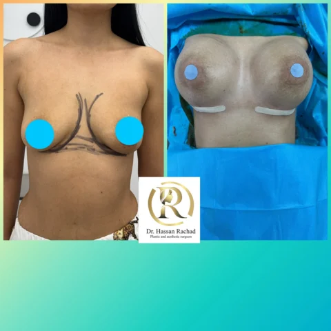 Caz implant mamar 037