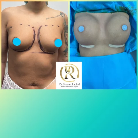 Caz implant mamar 038