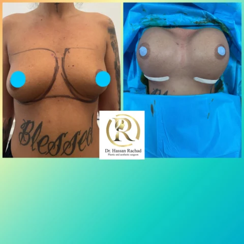 Caz implant mamar 040