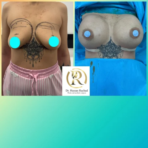 Caz implant mamar 044