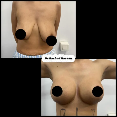 Caz implant mamar 048