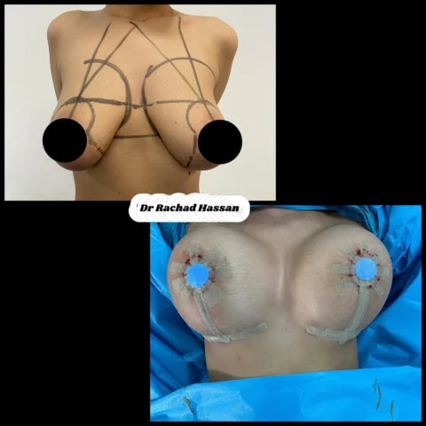 Caz implant mamar 050