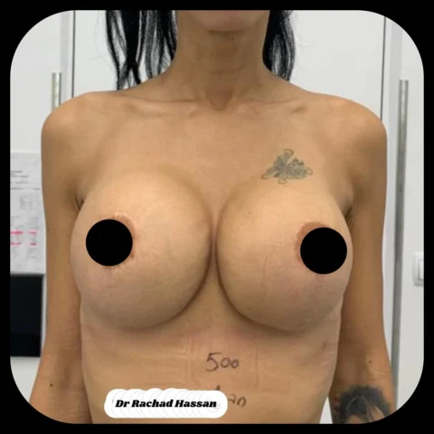 Caz implant mamar 052