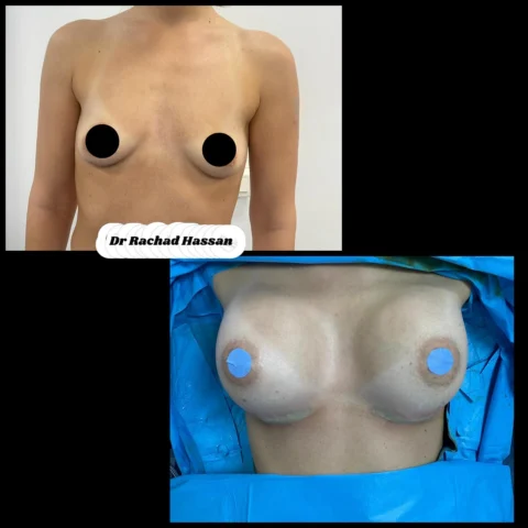 Caz implant mamar 058