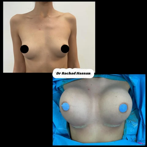 Caz implant mamar 060