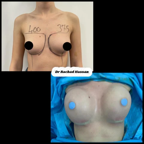 Caz implant mamar 061