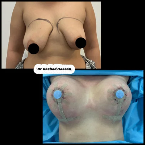Caz implant mamar 066