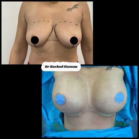 Caz implant mamar 067