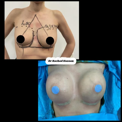 Caz implant mamar 073