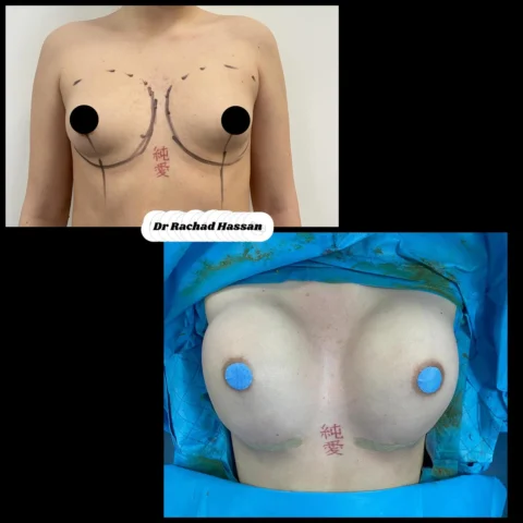 Caz implant mamar 074