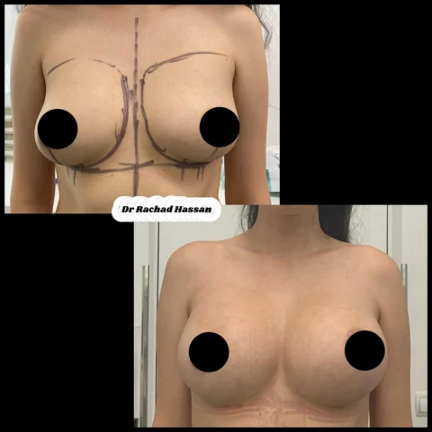 Caz implant mamar 079