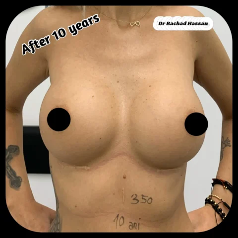 Caz implant mamar 080