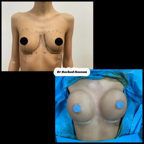 Caz implant mamar 081