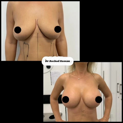 Caz implant mamar 085